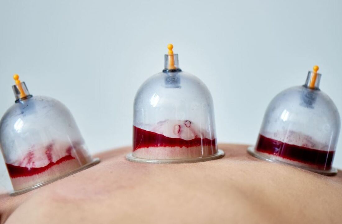 Hijama